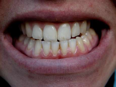 O principal sintoma do bruxismo é ranger os dentes enquanto dorme ou então cerrar e apertar dentes os dentes demais na hora do seu sono. O principal sintoma do bruxismo é ranger os dentes enquanto dorme ou então cerrar e apertar dentes os dentes demais na hora do seu sono.