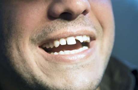 Em caso de muito sangramento: pressione diretamente a área com um pano limpo. Em caso de muito sangramento: pressione diretamente a área com um pano limpo.
