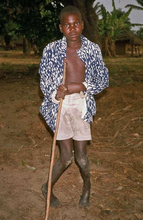 Menino com konzo, fotografado no Zaire (atual República Democrática do Congo) em setembro de 1986 Menino com konzo, fotografado no Zaire (atual República Democrática do Congo) em setembro de 1986