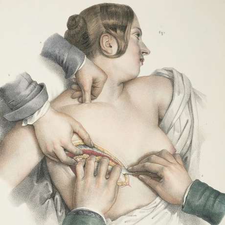 Durante o século 20, a mastectomia radical era um procedimento comum para pacientes com câncer de mama Durante o século 20, a mastectomia radical era um procedimento comum para pacientes com câncer de mama