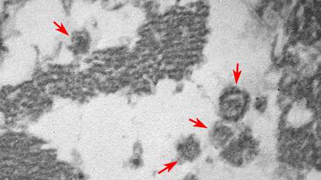 Imagem gerada por microscopia eletrônica revela 'a presença de vírus com tamanho e forma de Sars-CoV-2 (indicados pelas setas) no interior das células musculares cardíacas lesadas'