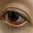 'Tive muito medo de ficar cega', disse influenciadora que sofreu hemorragia ocular