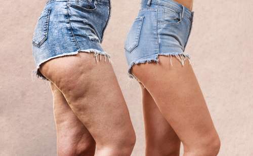 Celulite: mitos e verdades que andam dizendo por aí