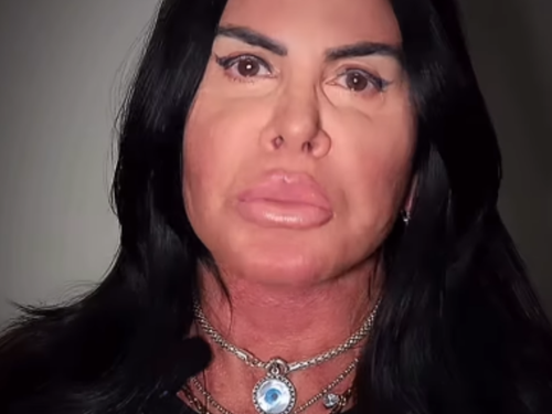 Gretchen faz nova harmonização facial e resultado surpreende; veja foto