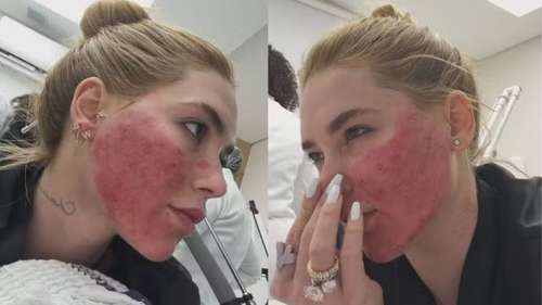 Influenciadora Virginia Fonseca expõe condição dermatológica e gera preocupação