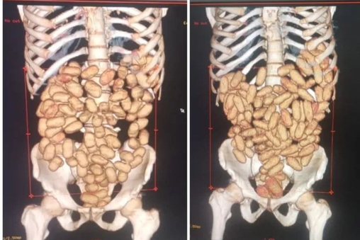 Raio-X mostra droga encontrada dentro de mula do tr&aacute;fico