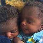 Siamesas sobrevivem a viagem de 15h na selva até hospital