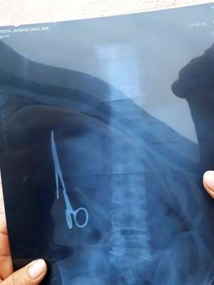 Homem é operado para retirar tesoura esquecida há 18 anos