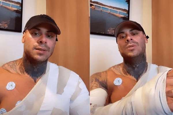 Leo Stronda mostra pela 1&ordf; vez ferimentos causados por acidente com botij&atilde;o  de g&aacute;s: 'Tudo &eacute; fase'