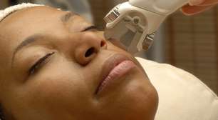 Com tecnologia inovadora, laser trata peles morenas e negras