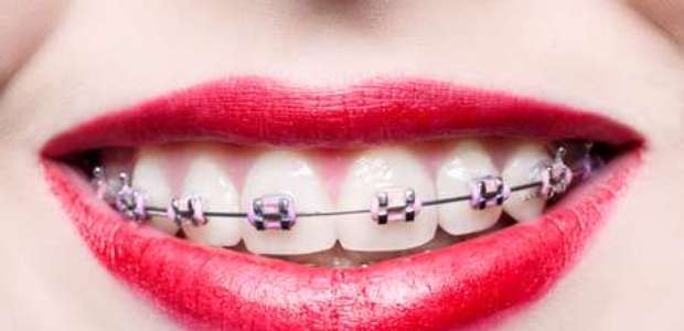 Quer alinhar o dente? Conheça os aparelhos e suas vantagens