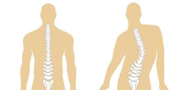 Escoliose na Adolescência