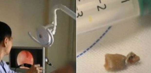 Dente cresce em nariz e homem não respira direito