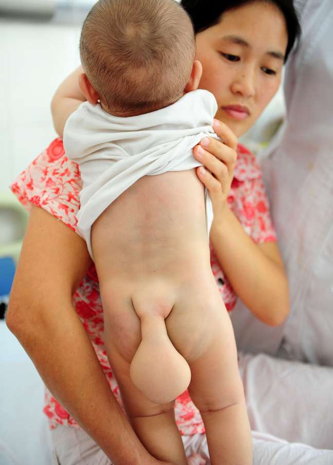 Menino chinês nasceu com uma "cauda". Segundo médicos, protuberância não pode ser retirada com cirurgia - pelo menos, não agora