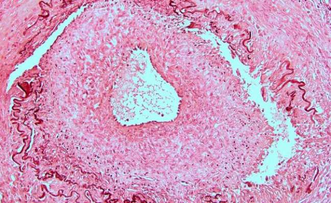 Imagem de uma artéria temporal danificada por arterite de células gigantes (GCA, sigla da doença em inglês) 