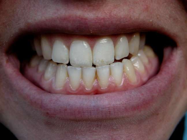O principal sintoma do bruxismo é ranger os dentes enquanto dorme ou então cerrar e apertar dentes os dentes demais na hora do seu sono.