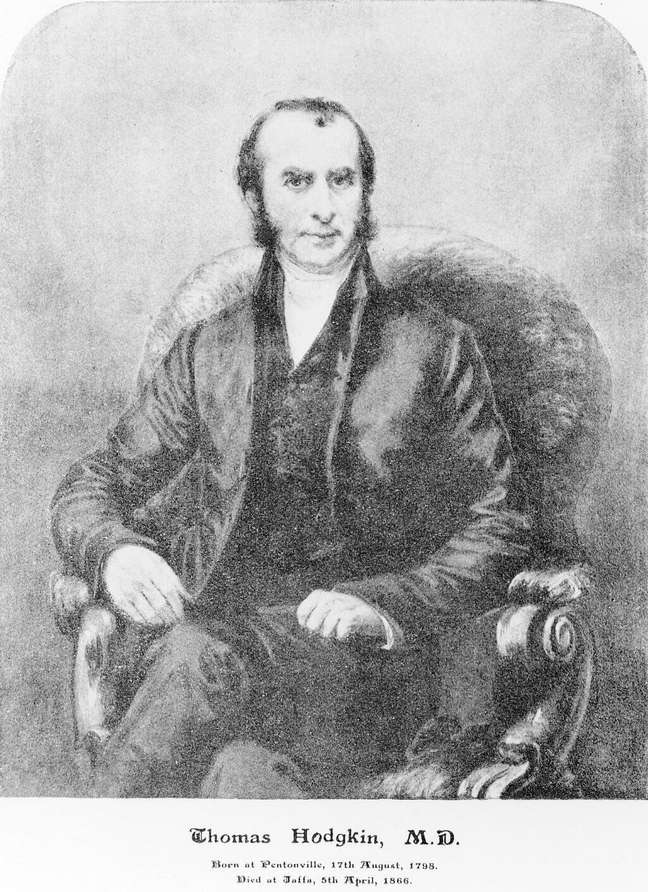 O linfoma de Hodgkin é nomeado em referência ao patologista Thomas Hodgkin O linfoma de Hodgkin é nomeado em referência ao patologista Thomas Hodgkin