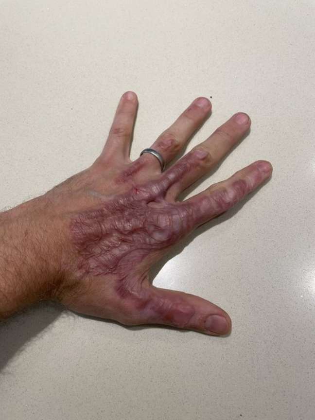 Grosjean mostra a mão esquerda em recuperação após cirurgias
