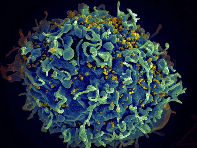Vírus do HIV (em amarelo) infectando uma célula humana