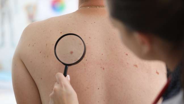 Descubra quais são os sintomas do câncer de pele