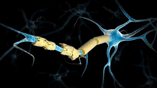 Na esclerose múltipla, há danos nas bainhas de mielina que protegem os neurônios no cérebro e na medula espinhal