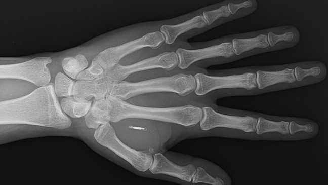 Um raio-x mostrando um implante Walletmor, que é injetado na mão de uma pessoa após um anestésico local