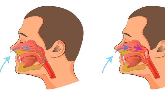 Quando a adenoide está inchada (como ilustrado à direita), o ar não passa pelas vias aéreas superiores