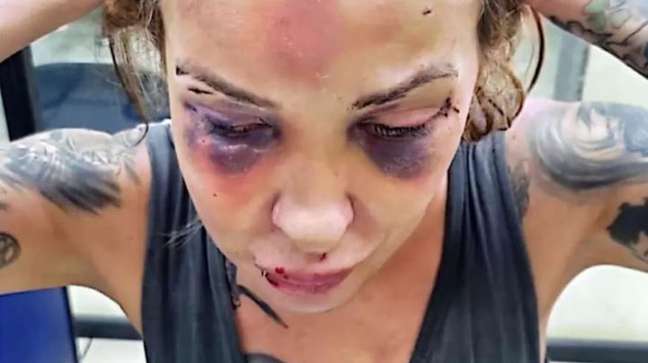 Luka Dias exibe lesões após agressões do namorado 