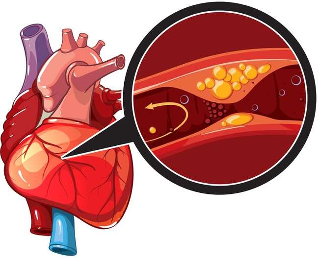 O entupimento das coronárias (as artérias do coração), como ilustrado na imagem, pode ter a ver com um estresse agudo