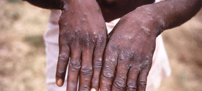Sintomas são semelhantes aos da varíola erradicada desde 1980
