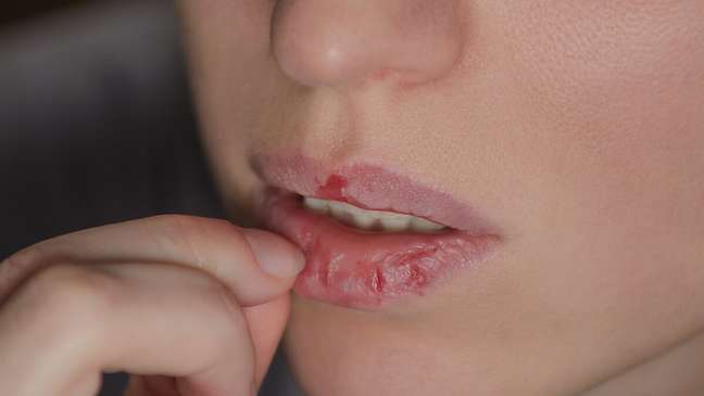 Boca ressecada? Dermatologista revela 5 atitudes que pioram o problema