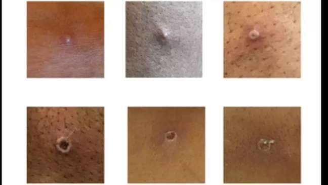 Coceira da varíola dos macacos passa por diferentes estágios até formação de lesões de pele Coceira da varíola dos macacos passa por diferentes estágios até formação de lesões de pele