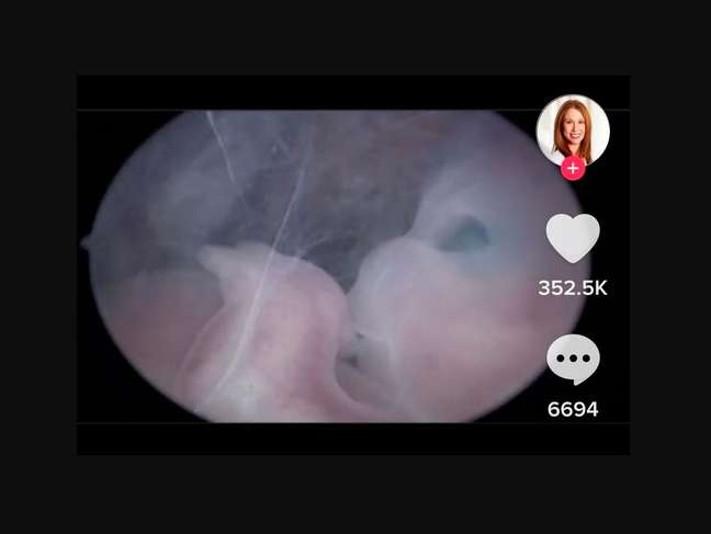 The breathtaking video shows a 10 week fetus in ectopic pregnancy