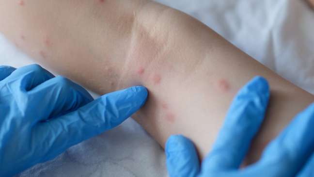 Community transmission of monkeypox in Brazil: what it means and how to deal with it