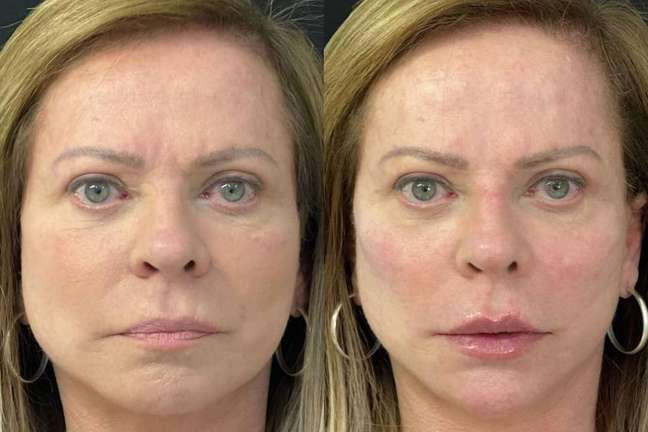 cheek filler before and after cheek filler before and after