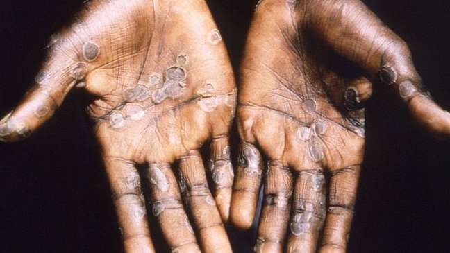 Hands with monkey pox Hands with monkey pox