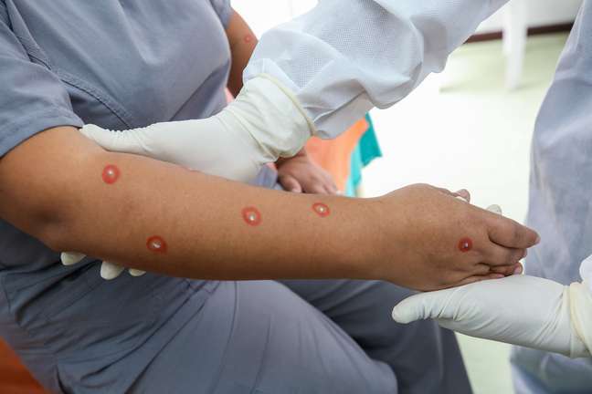 Woman injured by monkeypox