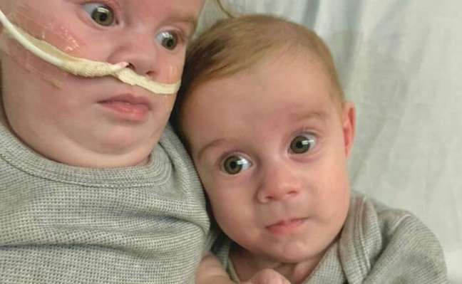 3D technology helps Siamese twins separation surgery 3D technology helps Siamese twins separation surgery
