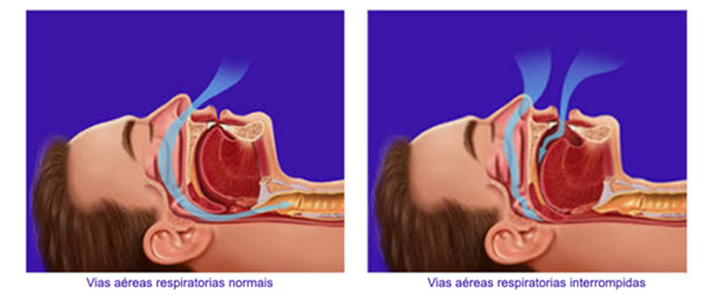 Obstructive sleep apnea blocks air passage 