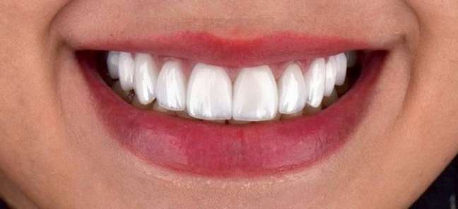 Treatment should only be indicated after verifying that the teeth, gums and other components of the oral cavity are healthy. Treatment should only be indicated after verifying that the teeth, gums and other components of the oral cavity are healthy.