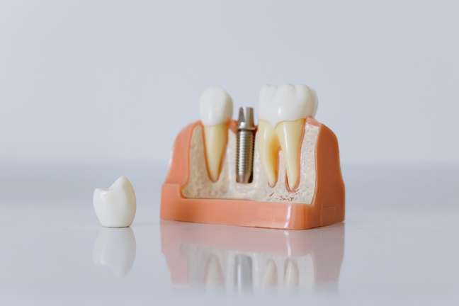 A colocação de um implante dental é um procedimento cada vez mais comum 