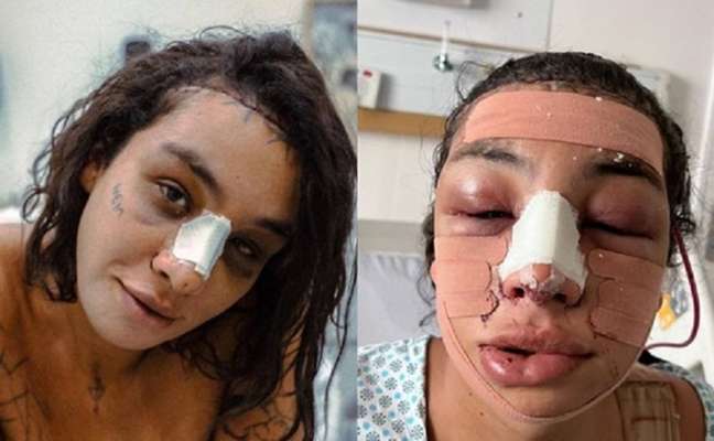 Linn da Quebrada shows the results after the gender affirmation surgery Linn da Quebrada shows the results after the gender affirmation surgery