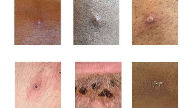 Alguns exemplos de lesões sugestivas de monkeypox
