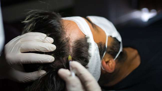 Inflitração com medicamentos e vitaminas no couro cabeludo é opção de tratamento a depender do diagnóstico do paciente