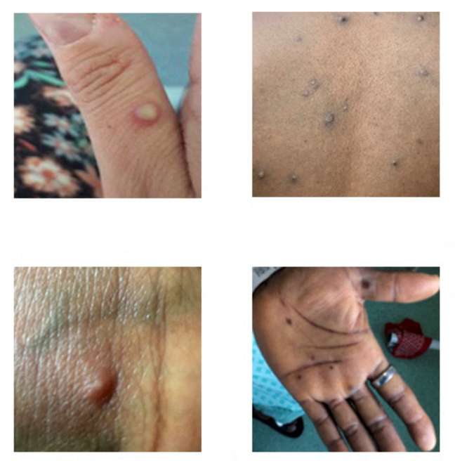 Alguns exemplos de lesões características do monkeypox