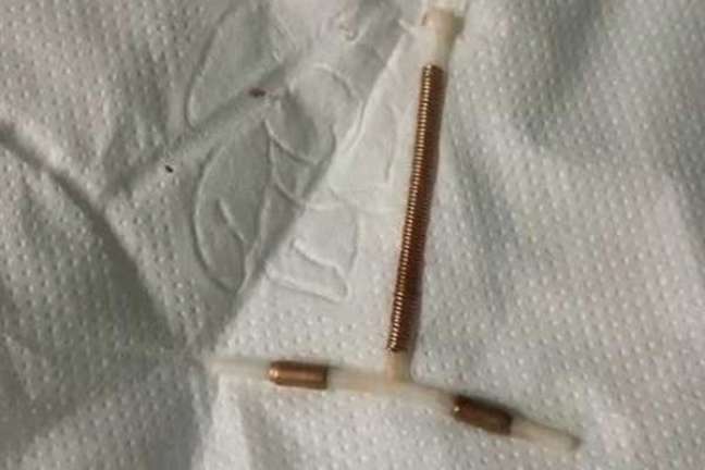The young woman goes viral when she takes out the IUD along with the swab. It’s possible? The young woman goes viral when she takes out the IUD along with the swab. It’s possible?