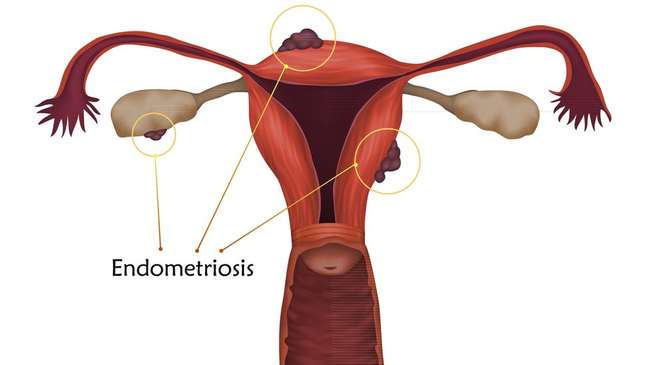 Endometriosis is the presence of tissue from the lining of the uterus - the endometrium - outside the uterus Endometriosis is the presence of tissue from the lining of the uterus - the endometrium - outside the uterus