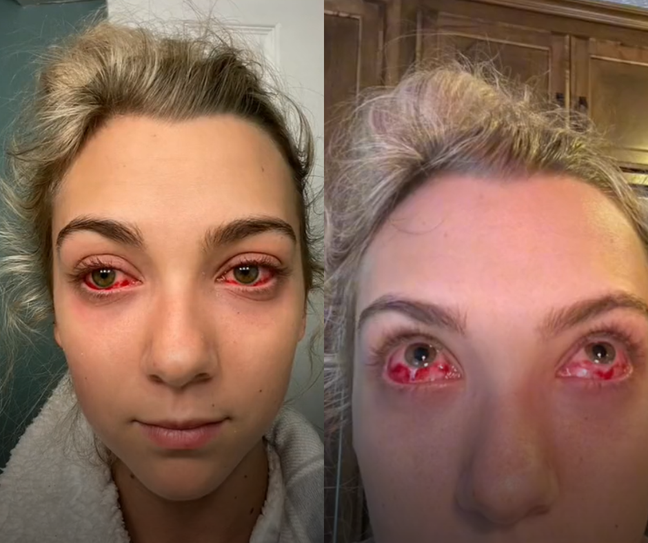 Young man has allergic reaction after eyelash extension and gets “zombie eyes”