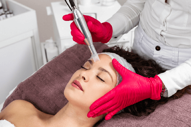 The results of microneedling are greater depending on the sessions The results of microneedling are greater depending on the sessions