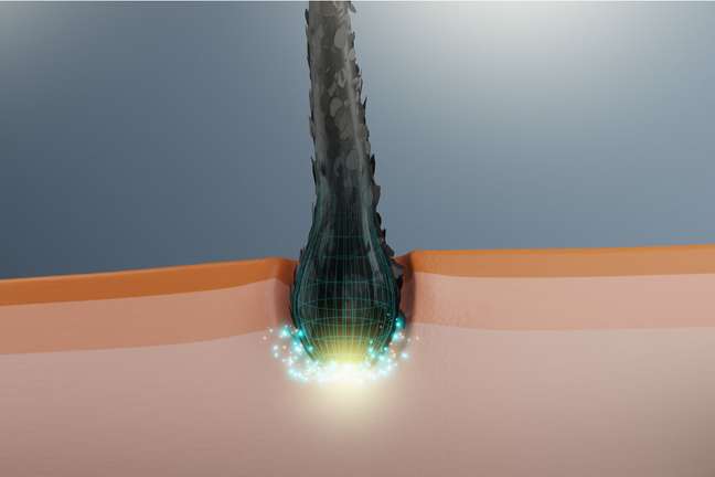 Hair transplant is considered a permanent solution for baldness Hair transplant is considered a permanent solution for baldness